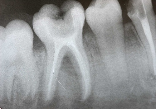 Radiographie numérique